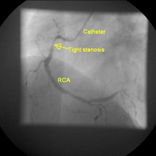 Tight proximal RCA stenosis – All About Cardiovascular System and Disorders