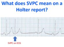 What does SVPC mean on a Holter report