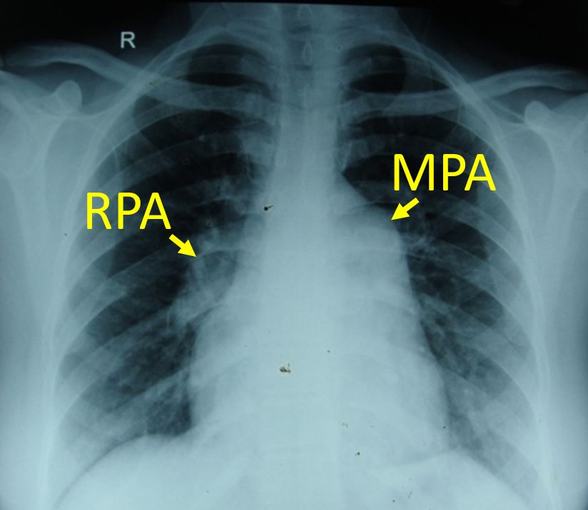 Annotated X-ray Chest PA View