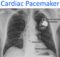 Cardiac Pacemaker