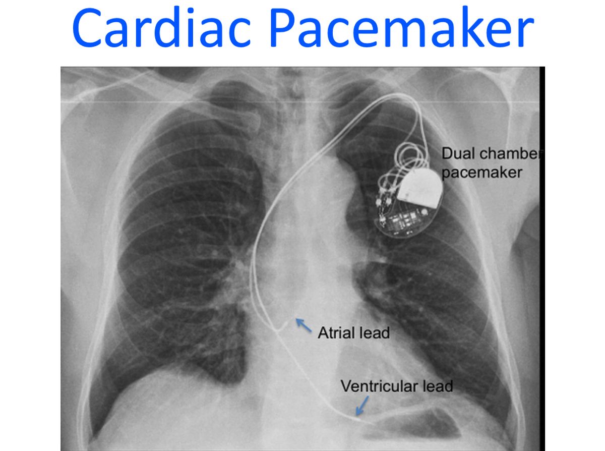 Cardiac Pacemaker