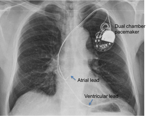 Dual chamber pacemaker - Chest X-ray