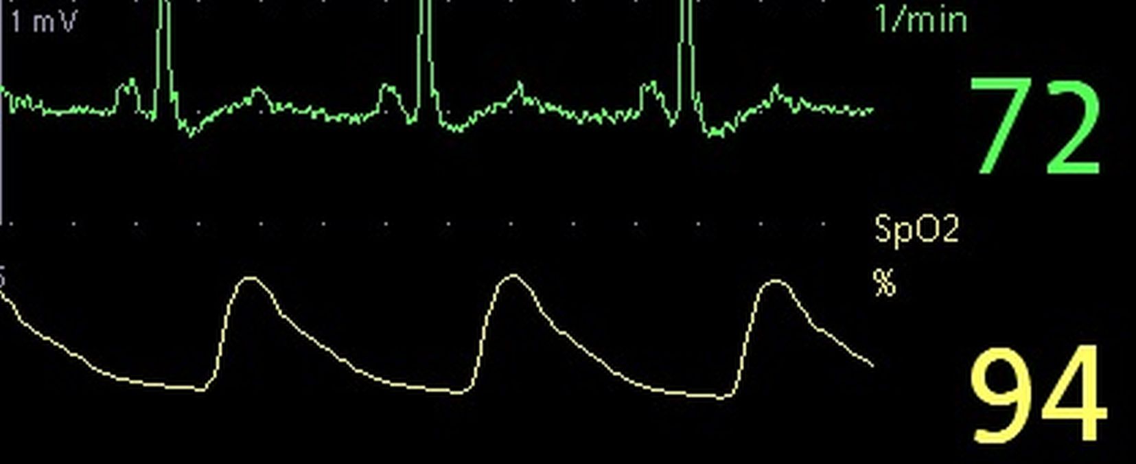 Pulsoximetry (SpO2) tracing