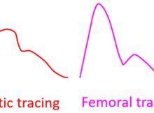 Aortic Pressure Tracing vs Femoral Arterial Pressure Tracing