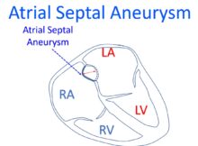 Atrial Septal Aneurysm