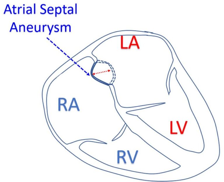 What Is A Atrial Septal Aneurysm