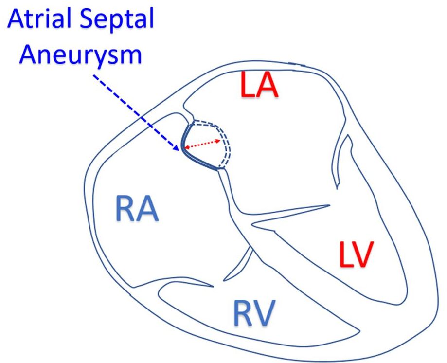 Atrial Septal Aneurysm