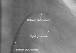 BMV balloon and guide wire