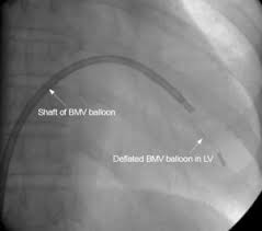 BMV balloon in left ventricle