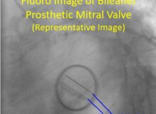 Fluoro Image of Bileaflet Prosthetic Mitral Valve (Representative Image)