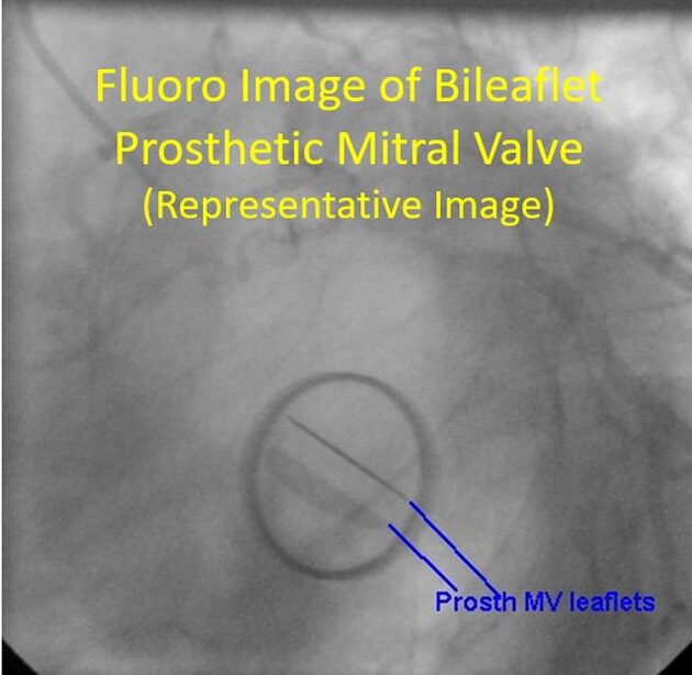 Fluoro Image of Bileaflet Prosthetic Mitral Valve(Representative Image)