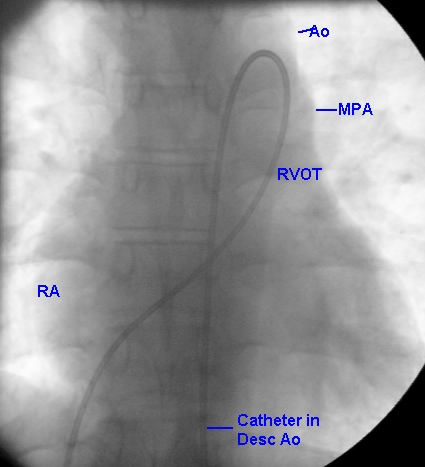 PA view of fluoroscopic image showing closed loop catheter position in patent ductus arteriosus (PDA)