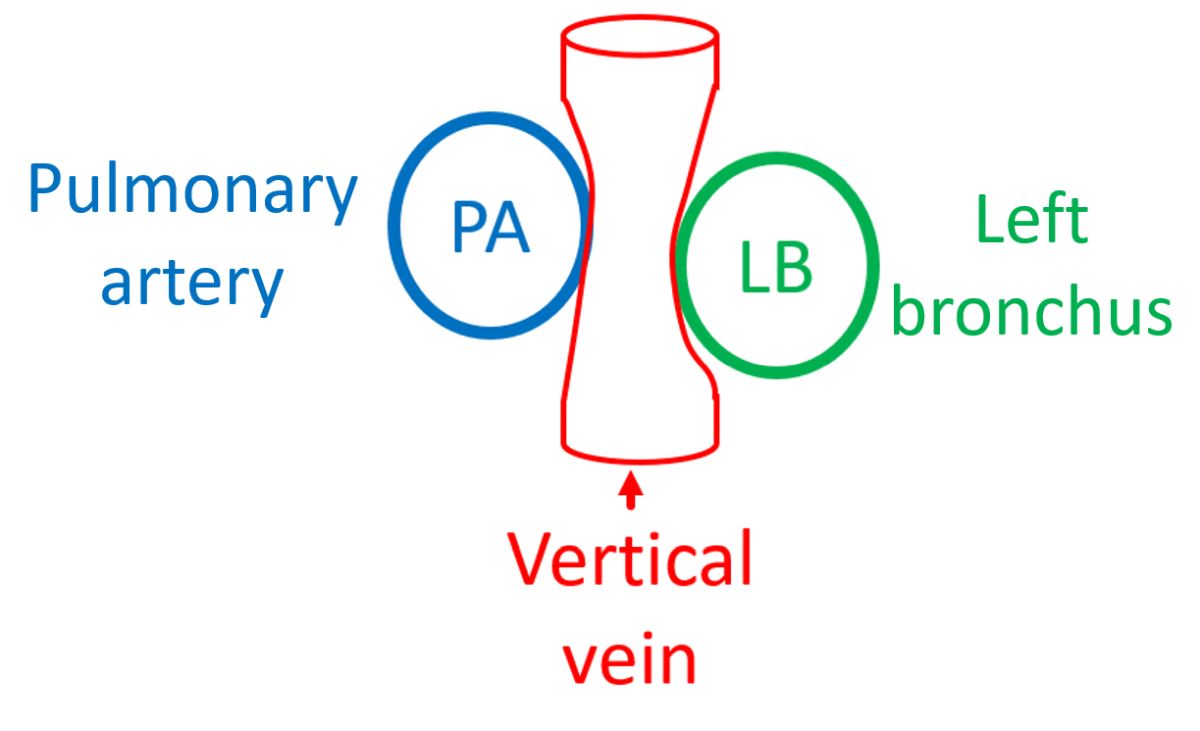 Compression of vertical vein between pulmonary artery and left bronchus