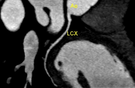 Cardiac CT scan image of LCX