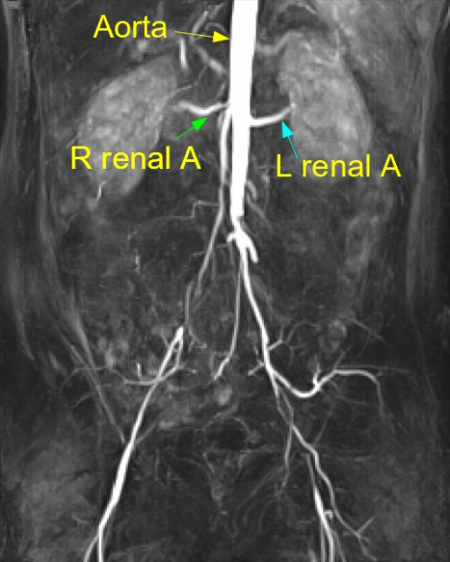 MR angio of aortoiliac disease