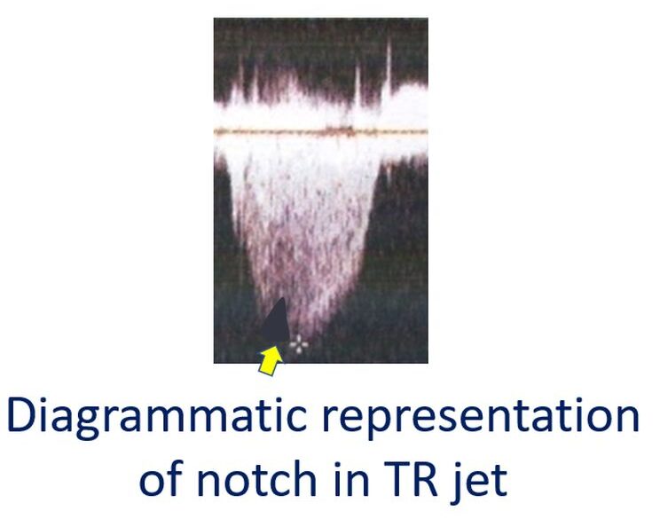 Notch in TR Jet in Complete Heart Block and Junctional Rhythm