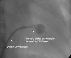 Partially dilated BMV balloon across mitral valve