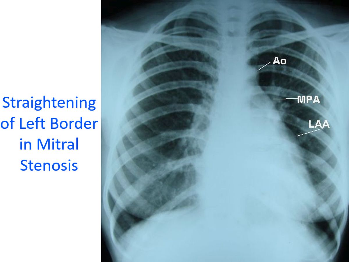 Aortic Stenosis X Ray