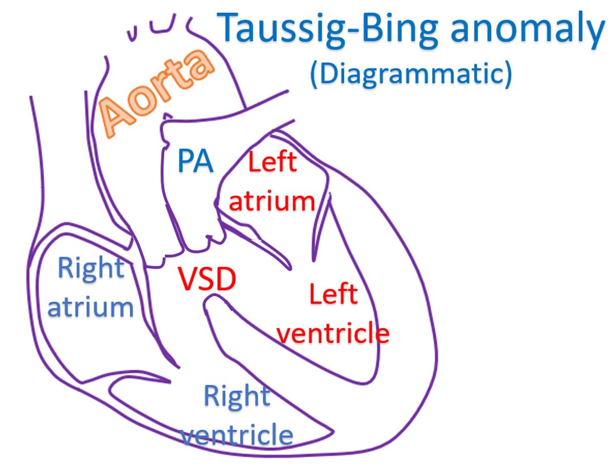 Taussig-Bing anomaly (Diagrammatic)