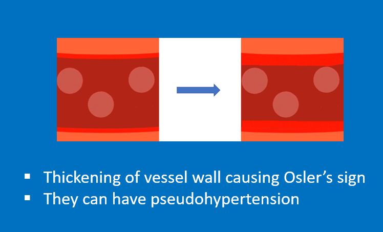 Thickened vessel wall causing Osler's sign and pseudo hypertension