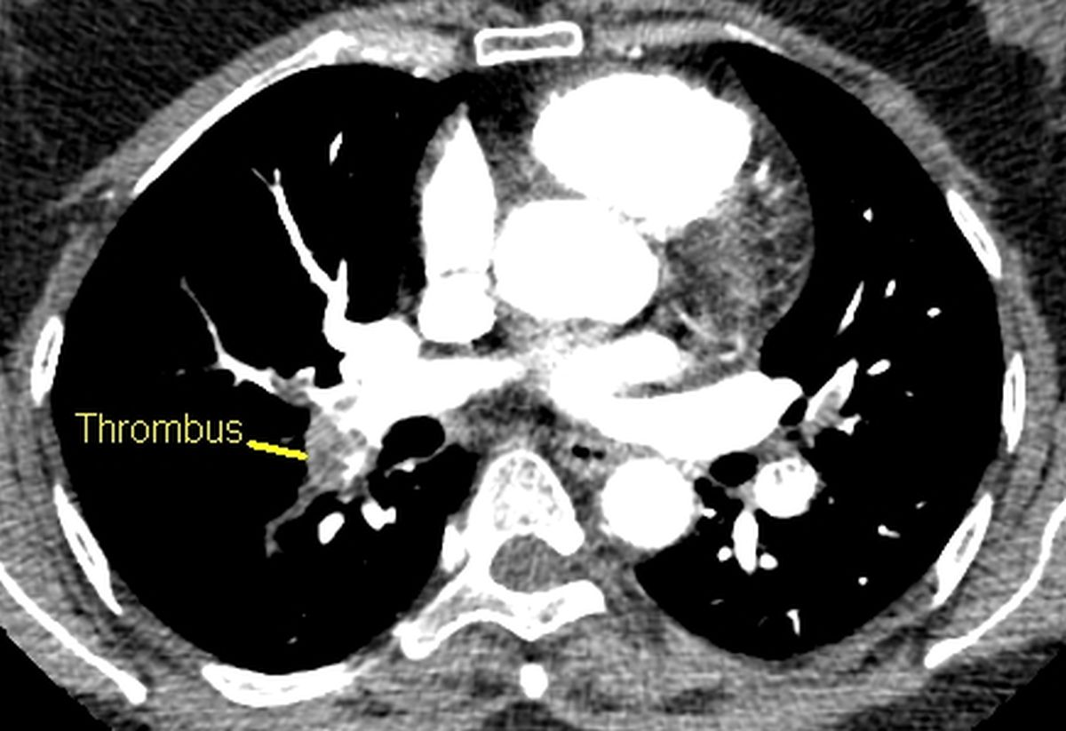 Thrombus in a branch of right pulmonary artery