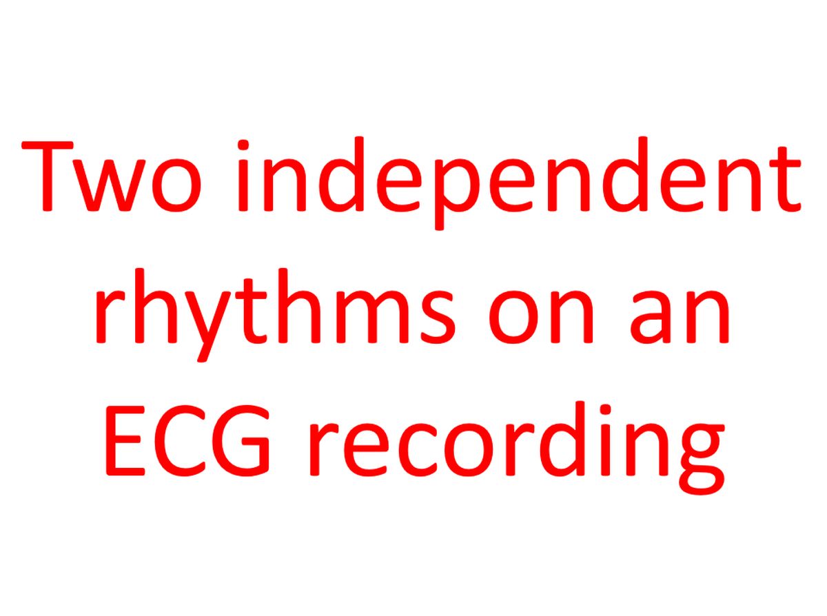 Two independent rhythms on an electrocardiographic recording