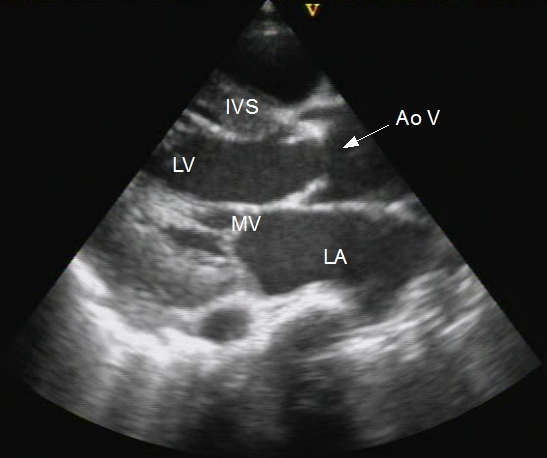 Aortic stenosis after balloon aortic valvotomy