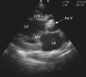 Echocardiogram In Aortic Stenosis