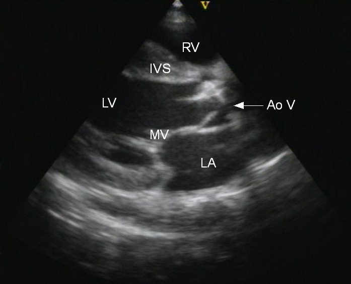 Aortic valve in open position. Leaflets are thickened