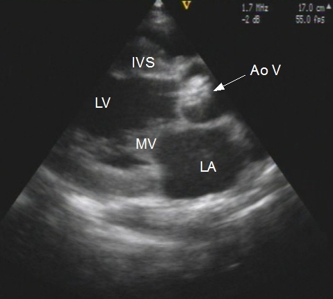 Aortic Stenosis - Thickened valve
