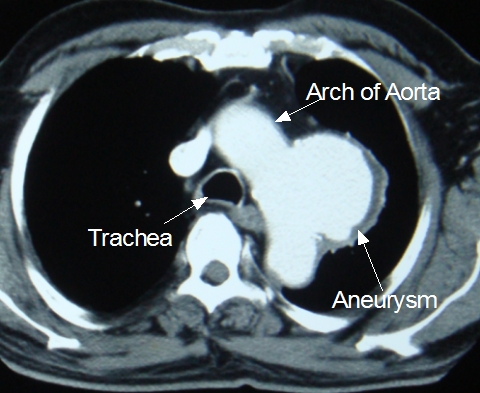 CT scan of aortic arch aneurysm