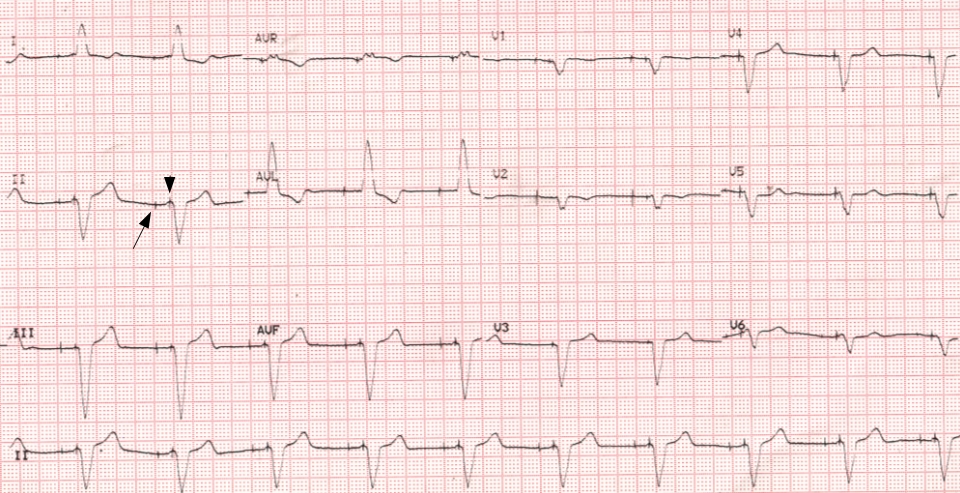 ecg-showing-atrial-and-ventricular-pacing-spikes-all-about