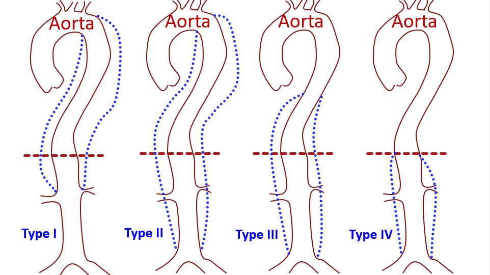 Crawford Coselli classification of Thoracoabdominal Aortic Aneurysm