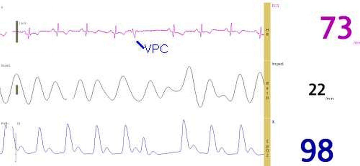 Pulse oximetry tracing of ventricular premature complex (VPC)