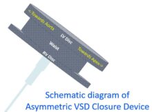 Schematic diagram of Asymmetric VSD Closure Device