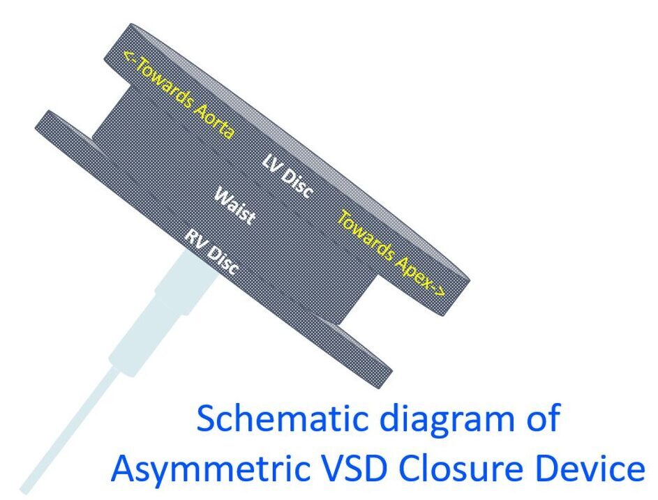 Schematic diagram of Asymmetric VSD Closure Device