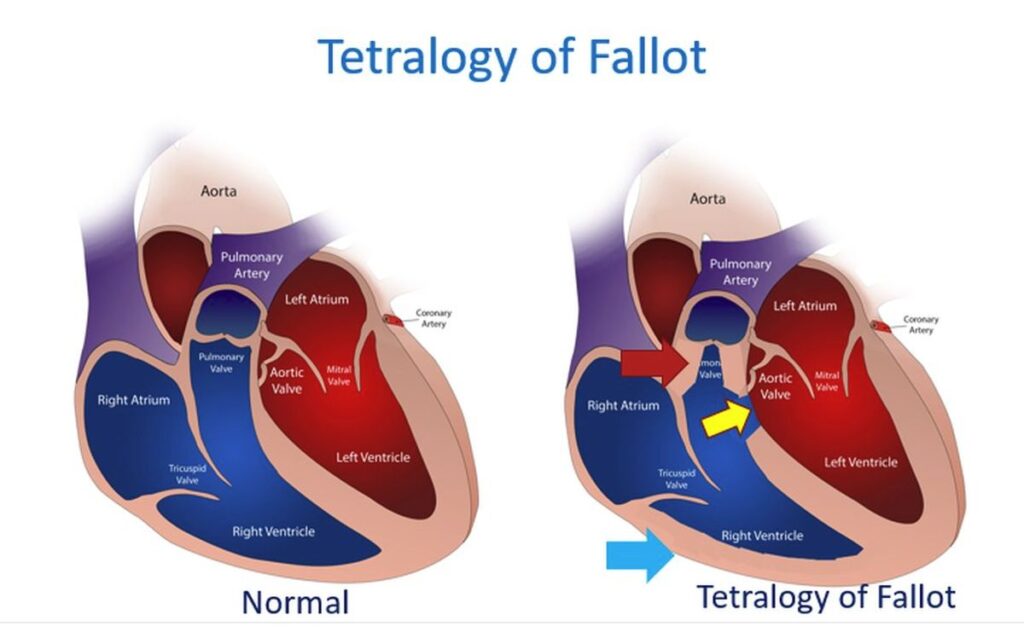 Fallot like physiology – All About Cardiovascular System and Disorders