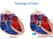 Tetralogy of Fallot (Diagrammatic)