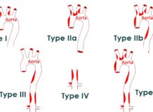 Angiographic classification of Takayasu arteritis (Schematic diagram)