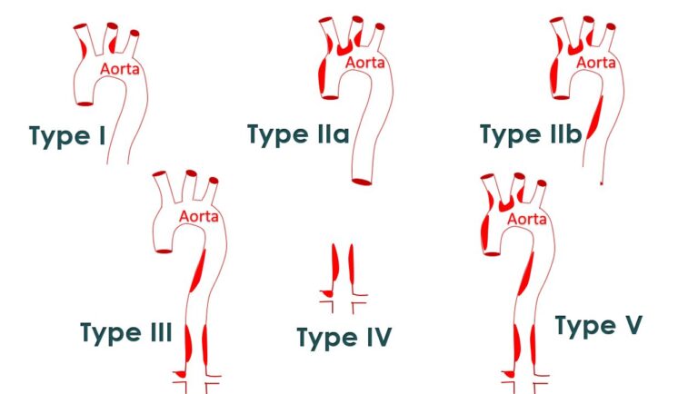 Angiographic classification of Takayasu arteritis – All About ...