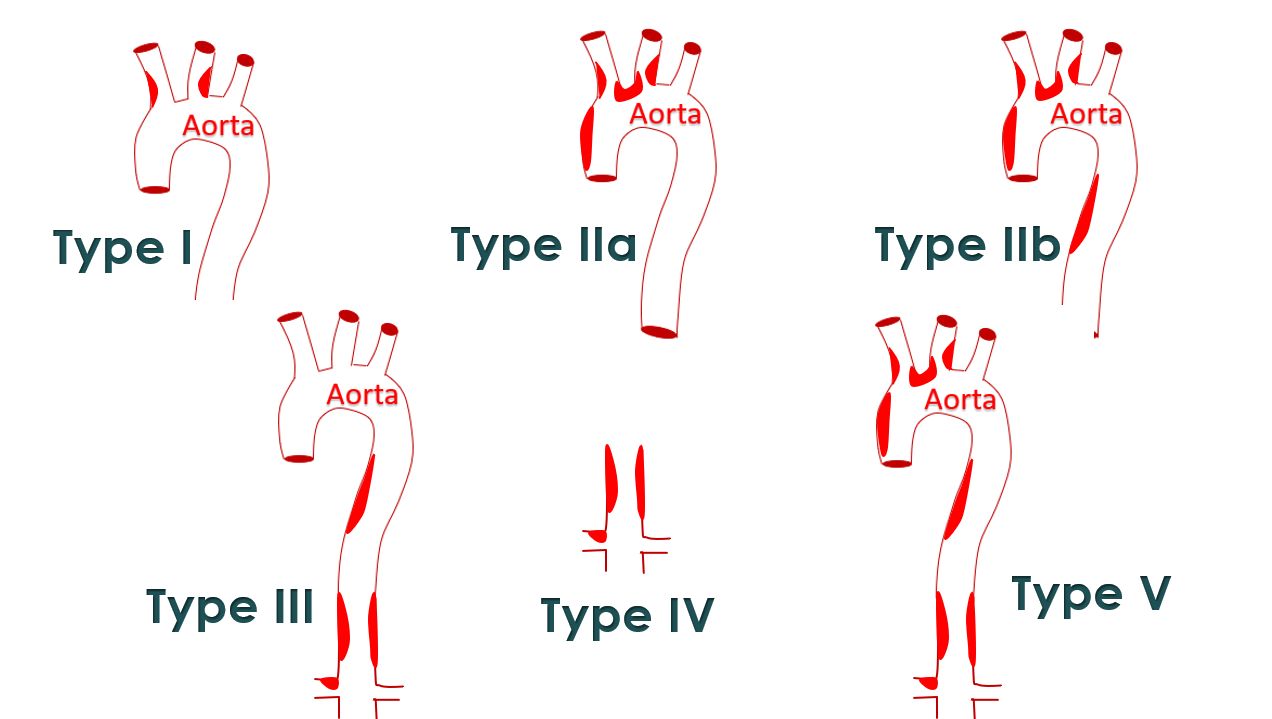 Schematic diagram of various types of Takayasu arteritis based on regions involved.