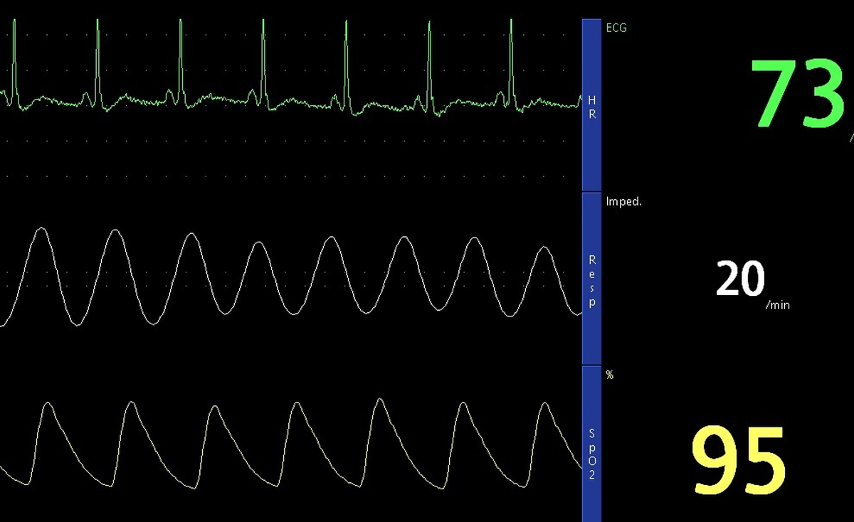ECG, Respiration and SpO2 tracings
