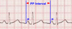 PP interval on ECG