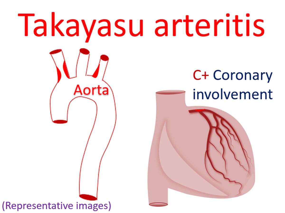 Takayasu arteritis with coronary involvement (Representative images)