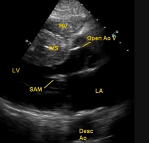 Systolic anterior motion (SAM) of mitral valve in hypertrophic obstructive cardiomyopathy