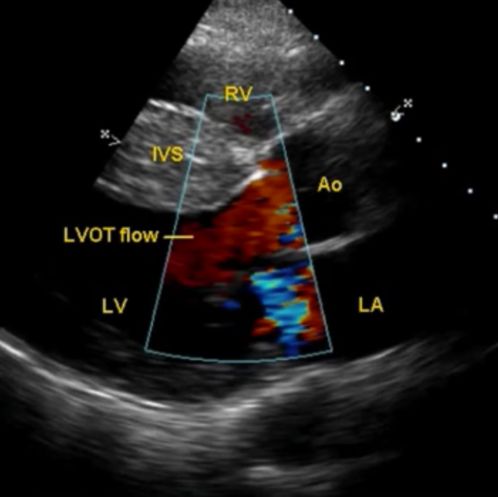 Colour flow mapping in early systole in hypertrophic cardiomyopathy