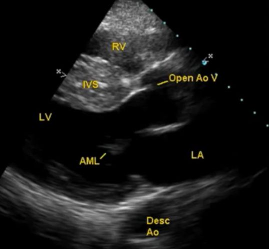 Early systolic frame in echocardiography in hypertrophic cardiomyopathy
