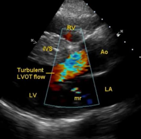 Hypertrophic obstructive cardiomyopathy with turbulent LVOT flow and mitral regurgitation by CFM