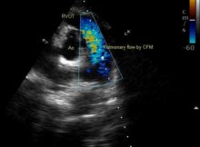 Circle and sausage appearance of aorta and pulmonary artery