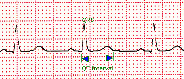 QT interval on ECG